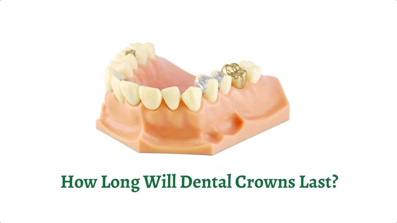 Dental Crowns Longevity: How Long Do They Last? 🦷
