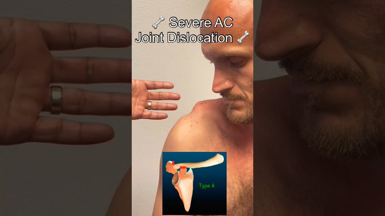 Severe AC Joint Dislocation Explained by Surgeon ⚕️