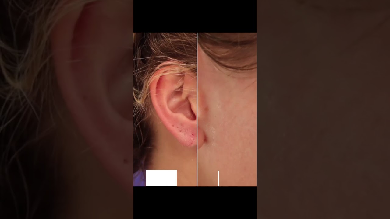 Reno Torn Earlobe Repair by Dr. Erez Dayan 👂