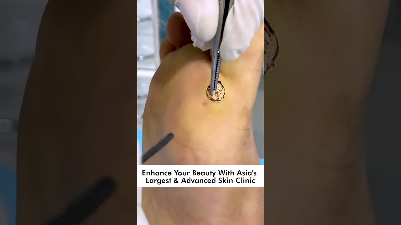 Removing Plantar Warts: Tips & Prevention 👣