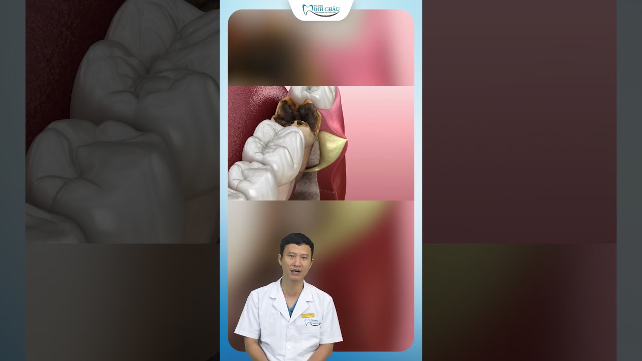 Viêm Quanh Chân Răng: Nguyên Nhân & Điều Trị 🦷