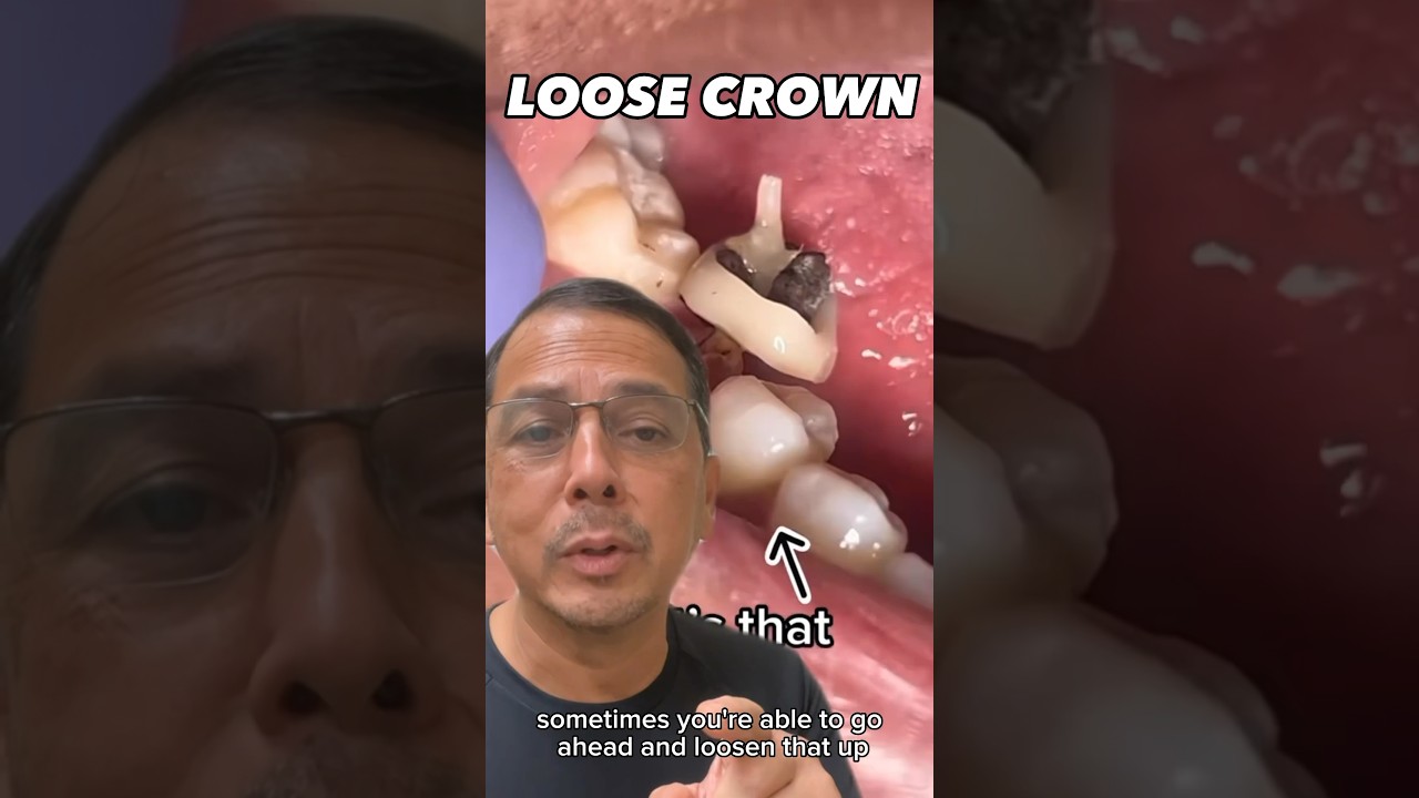 Dentist Removes Loose Dental Crown 🦷