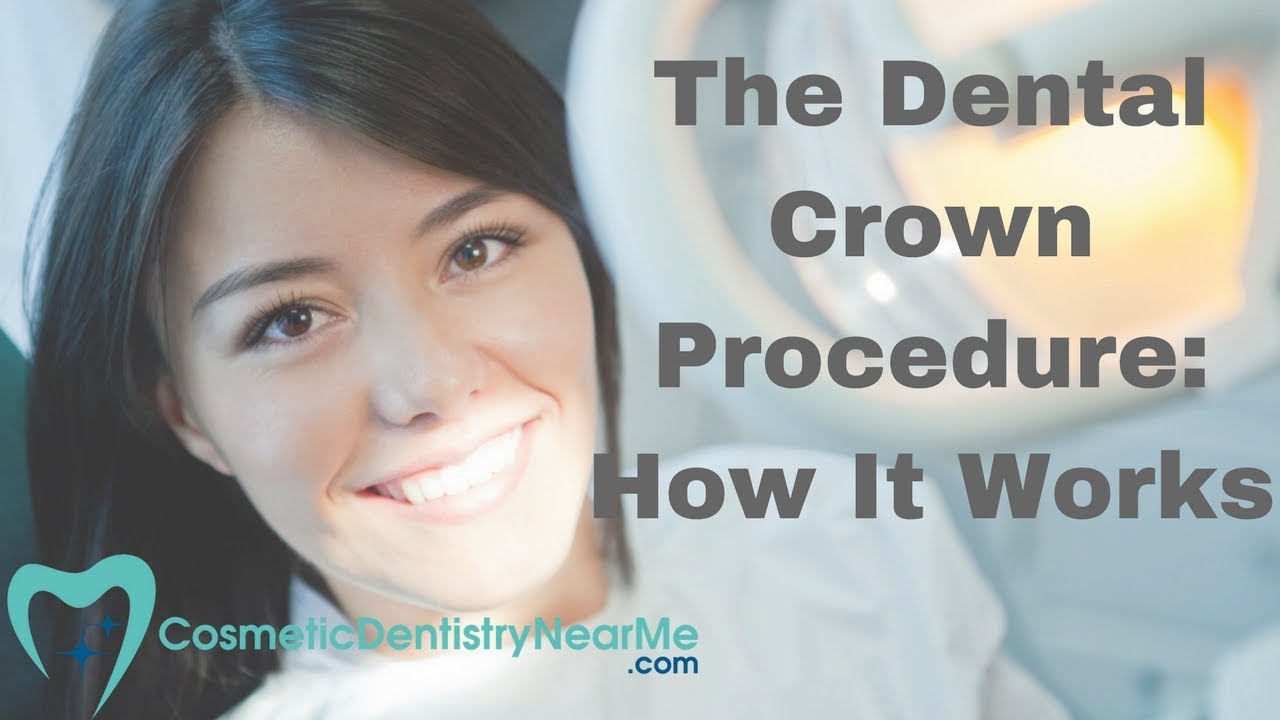 Dental Crown Procedure Explained 🦷