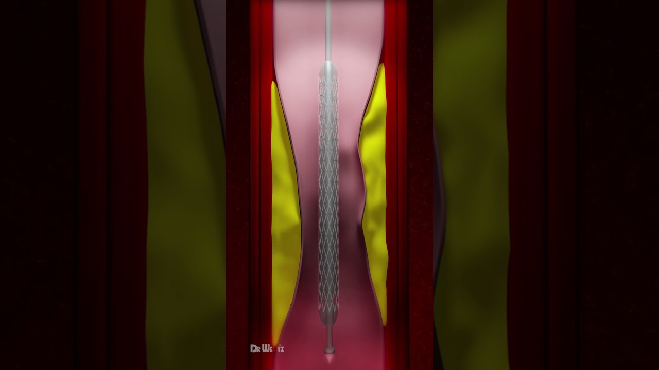 How a Coronary Artery Stent Is Placed: Step-by-Step Animation 🩺