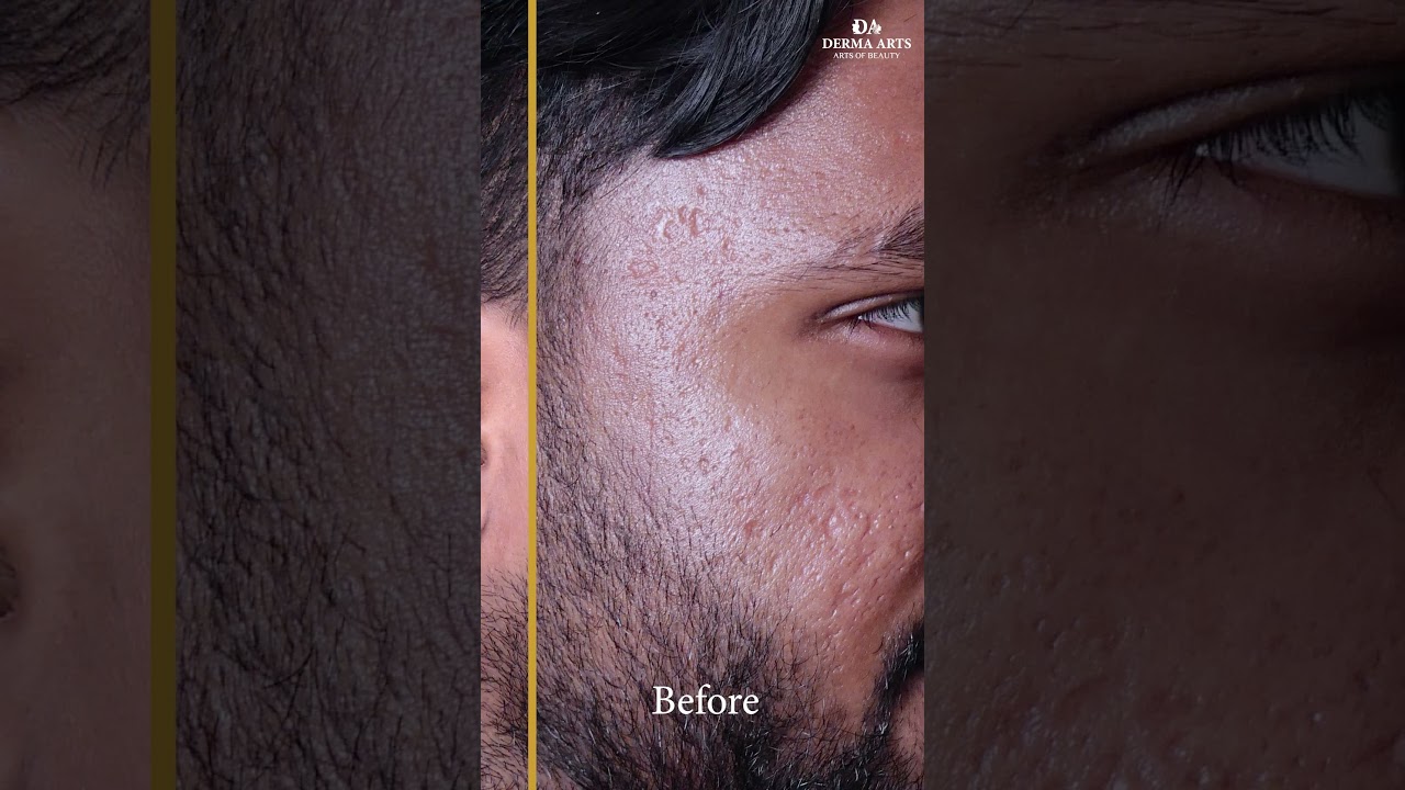 Hydra Facial Before & After | Dr. Mitra Amiri ✨
