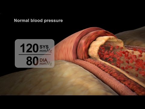 High Blood Pressure Diagnosis | NUCLEUS Medical