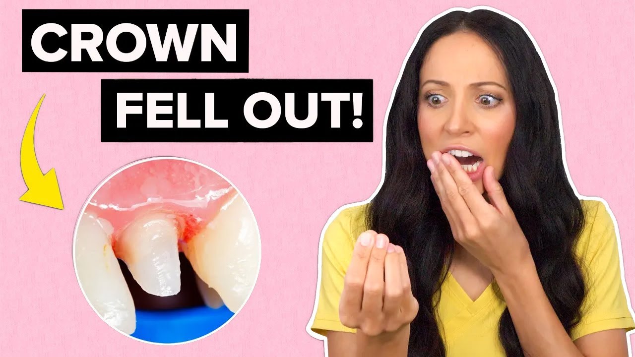 What to Do If Your Dental Crown Falls Out 🦷
