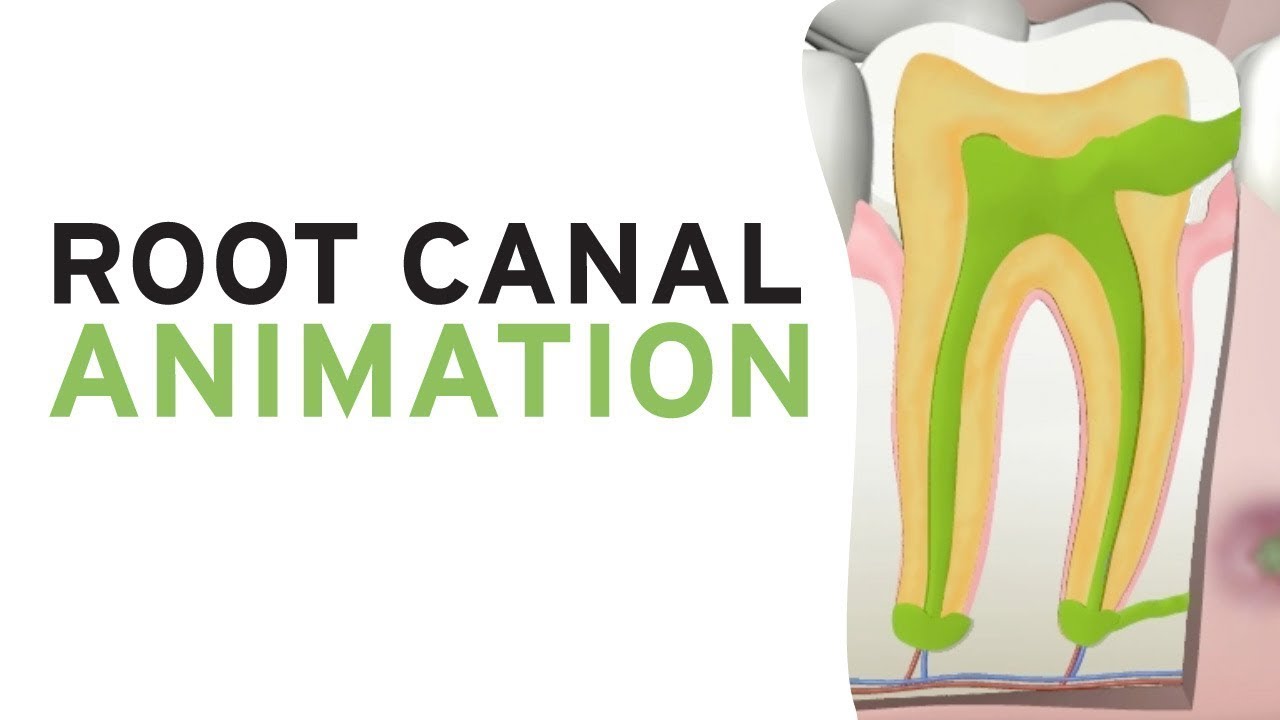 Root Canal Treatment (RCT) Step-by-Step Animation 🦷