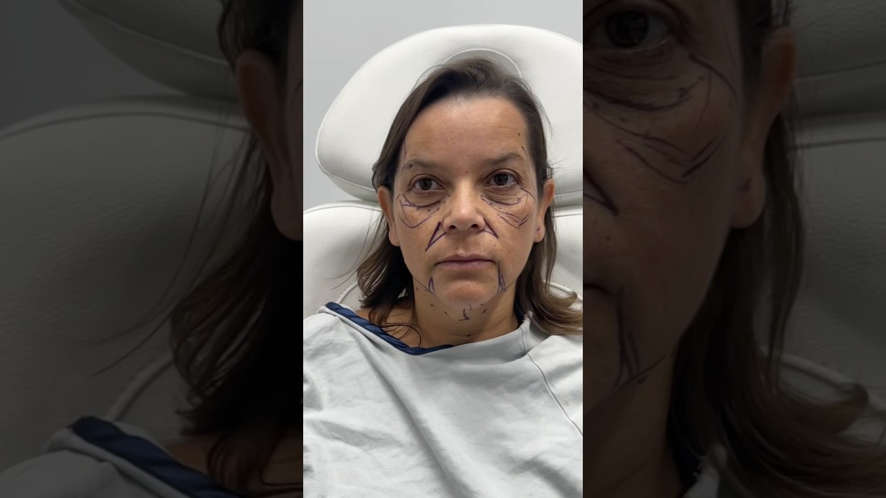 I Took Away 15 Years π± Facelift Done Right! #plasticsurgery