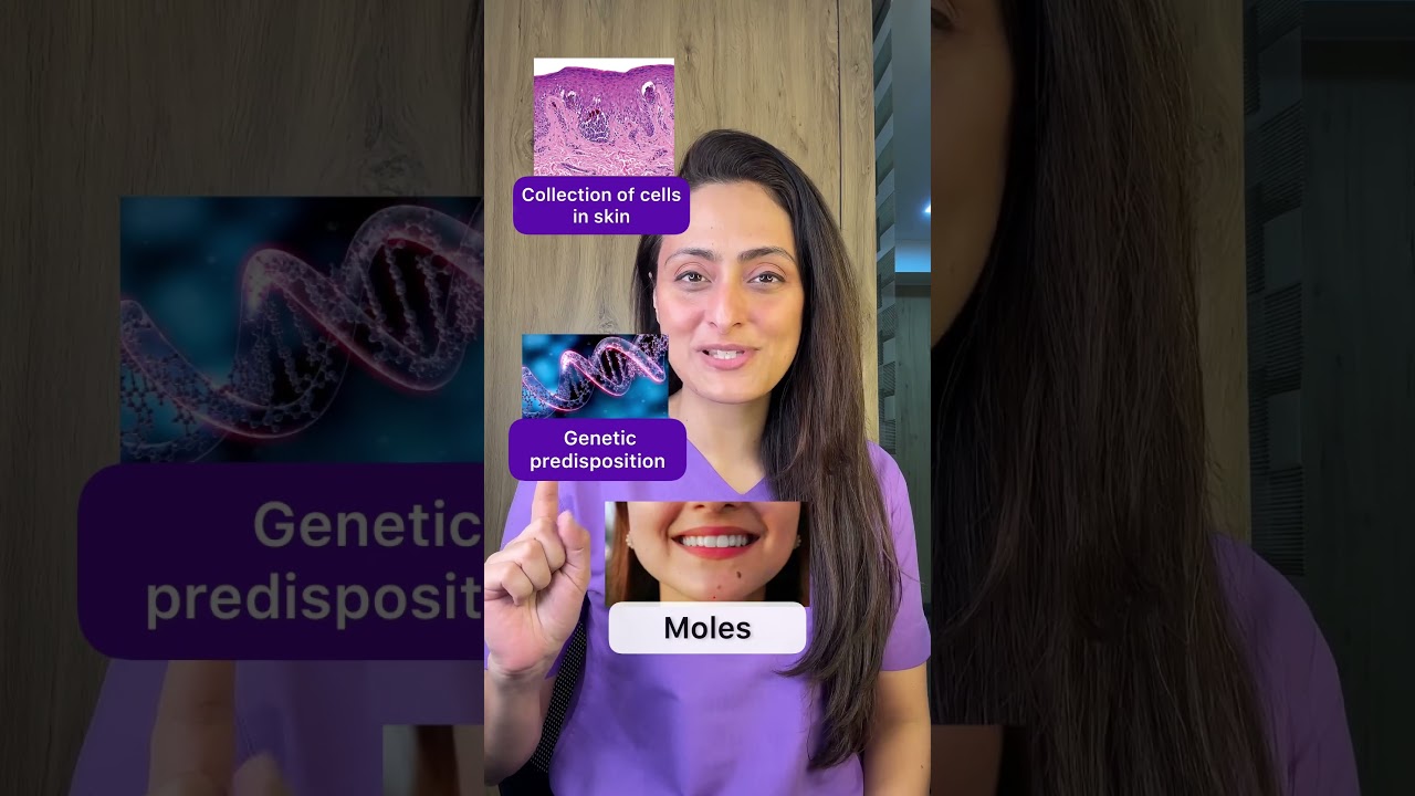 Moles: Causes, Treatment & Tips from Dermatologists