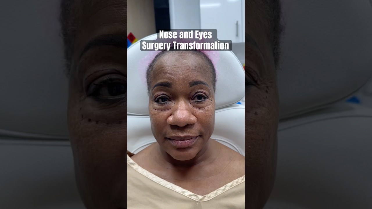 African American Nose & Eyelid Surgery Results 🤩
