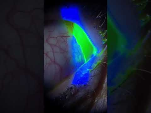 How to Remove a Torn Contact Lens ๐๏ธ