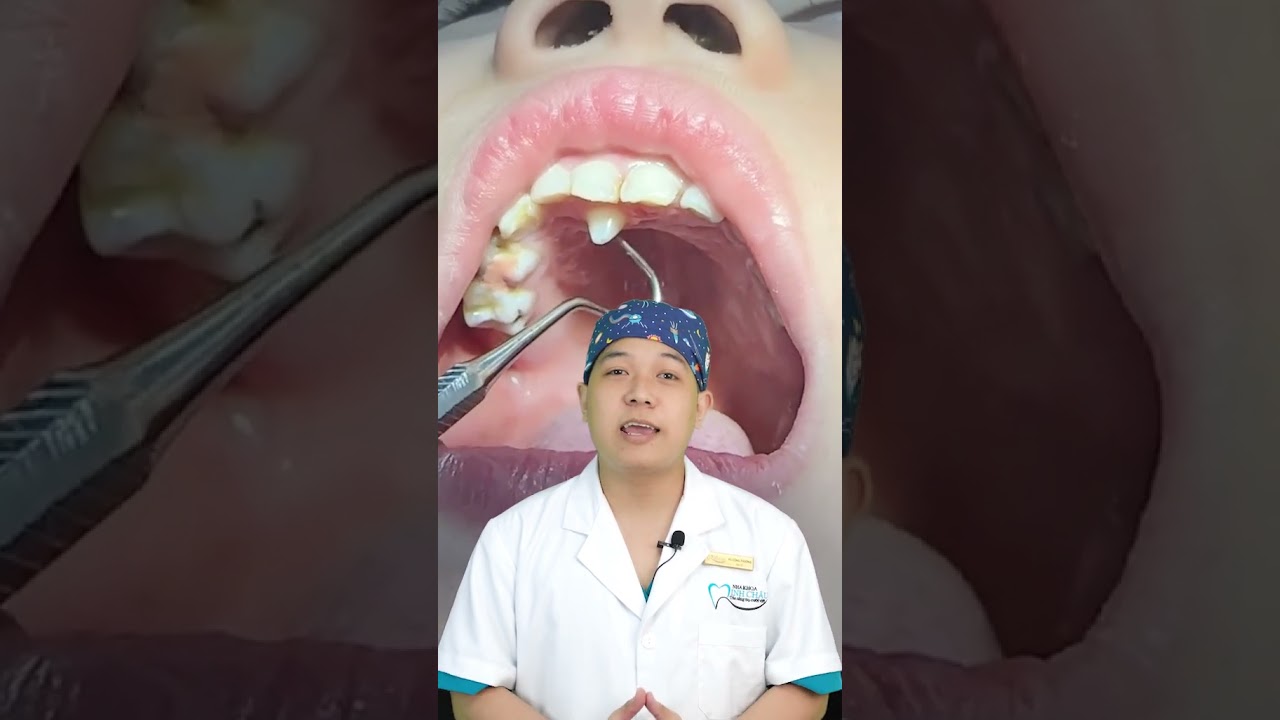 Răng Kẹ Mọc Thừa: Tìm Hiểu & Điều Trị 🦷