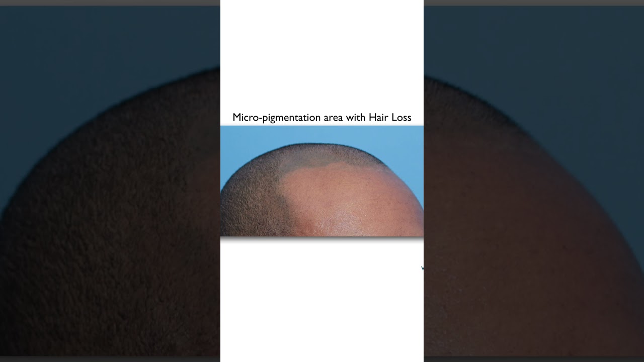 Long-Term Results of Scalp Micropigmentation ✨