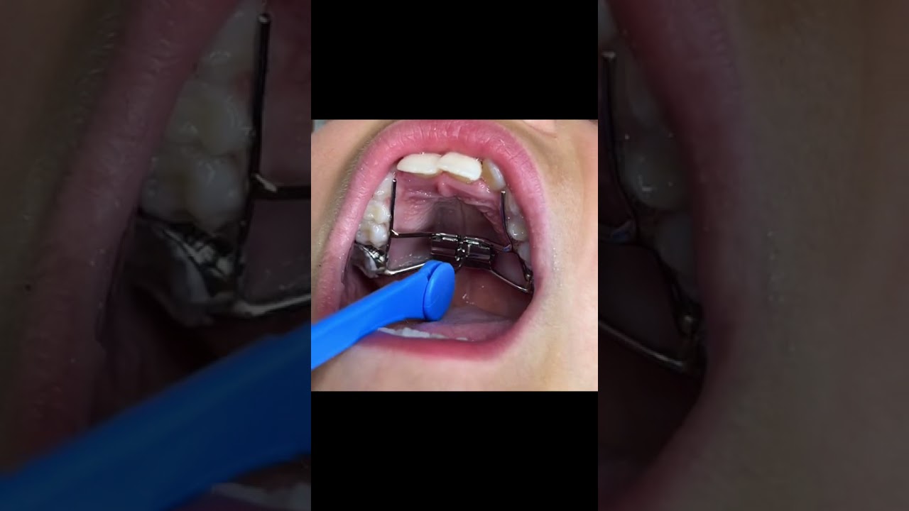 How to Activate an Expander π§