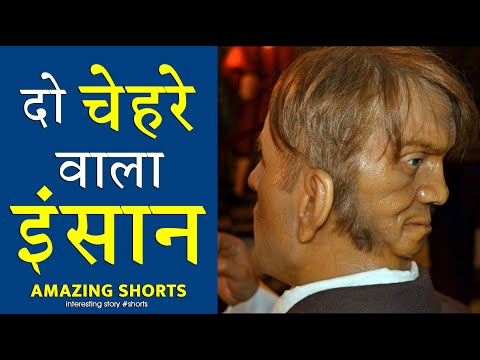 दुनिया का पहला दो चेहरे वाला इंसान 😲 Amazing Facts #shorts
