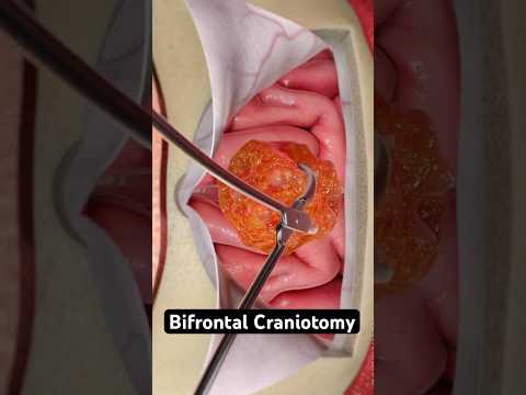 Removing a tumor from your brain (3D Animation)