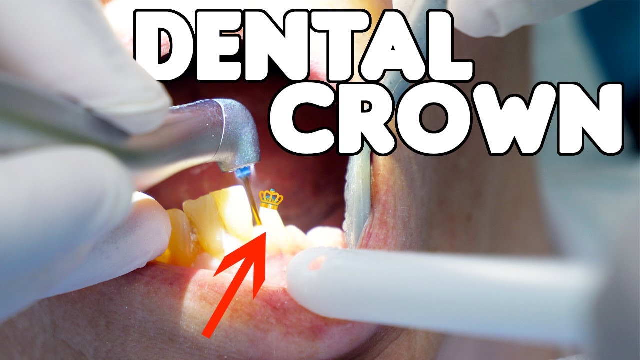 Dental Crown Placement Explained 🦷