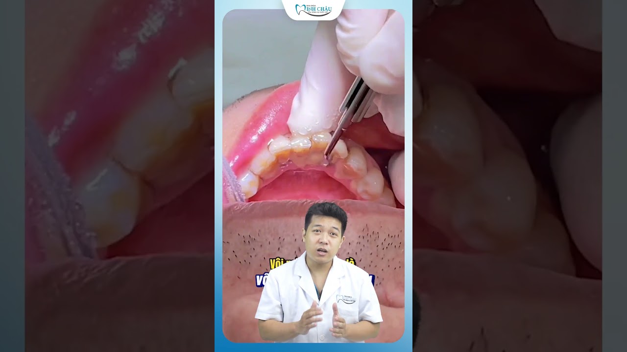 30 Hậu quả của 30 năm không lấy cao răng 🦷
