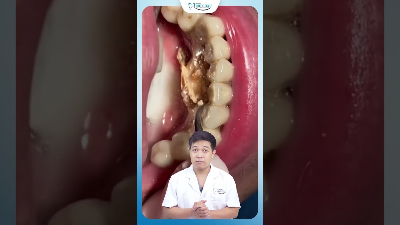 Quan Niệm Sai Về Việc Lấy Cao Răng 🦷