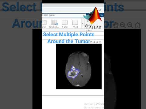 Extract Tumor by Image Segmentation MATLAB- DICOM image