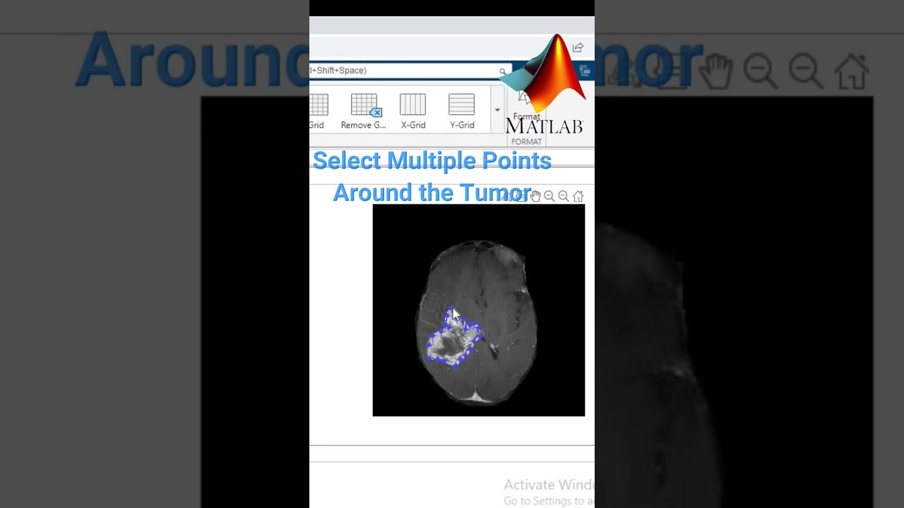 Tumor Extraction Using Image Segmentation in MATLAB for DICOM Images