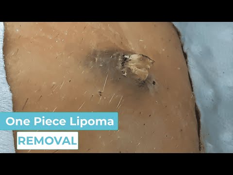 [ASMR] Huge Blackhead Most Satisfying Removal, Skincare Transformation Dr. Pimple Popper 1710 083251