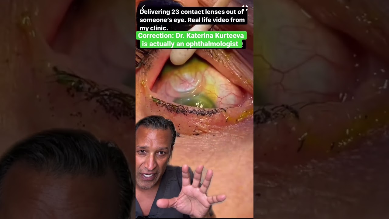 Removing 23 Contact Lenses Stuck in Eye 👁️