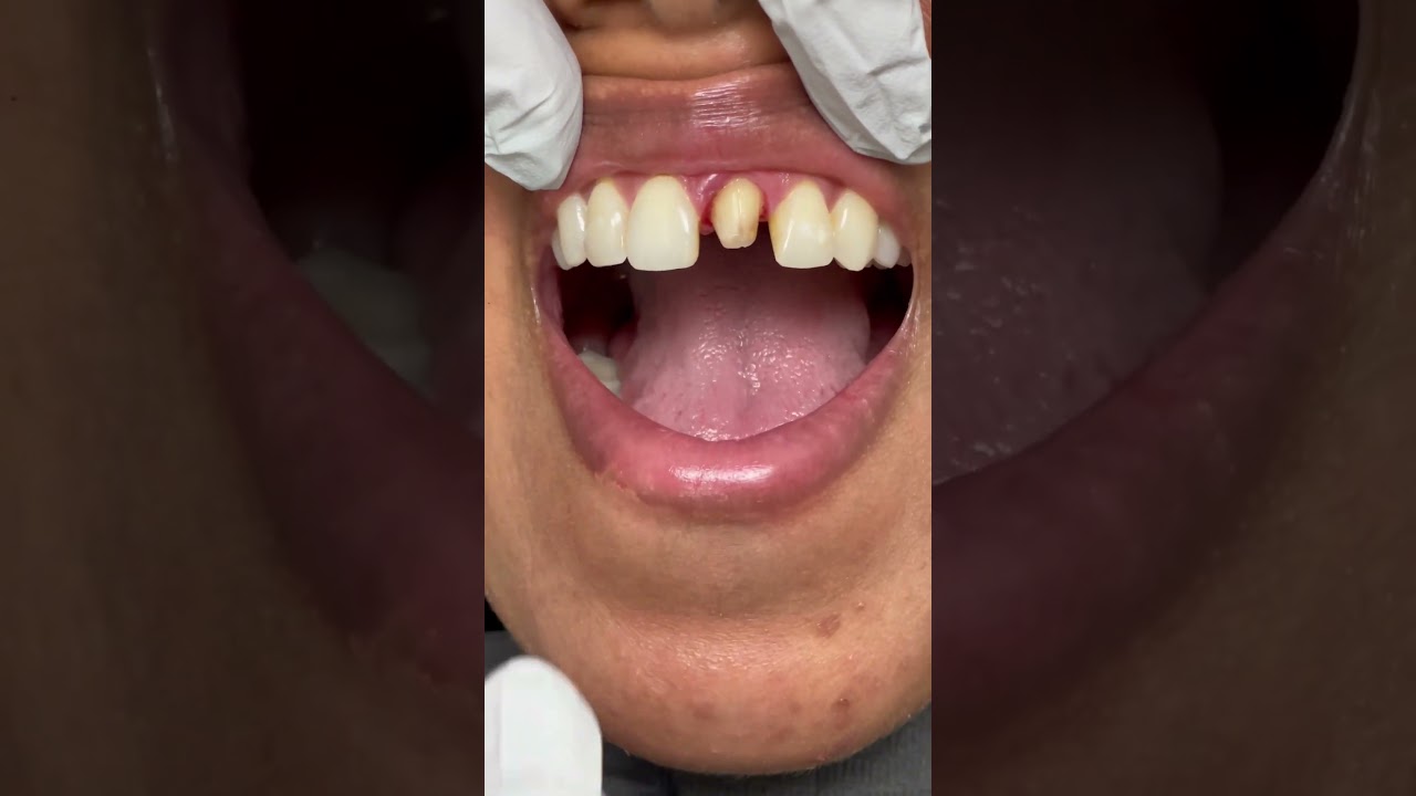 Invisible Front Crown for a Perfect Smile 😊