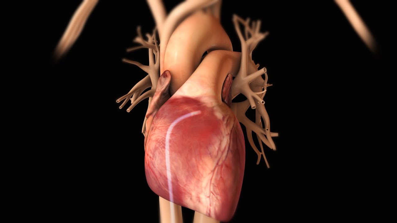 Understanding Cardiac Arrhythmia 🫀