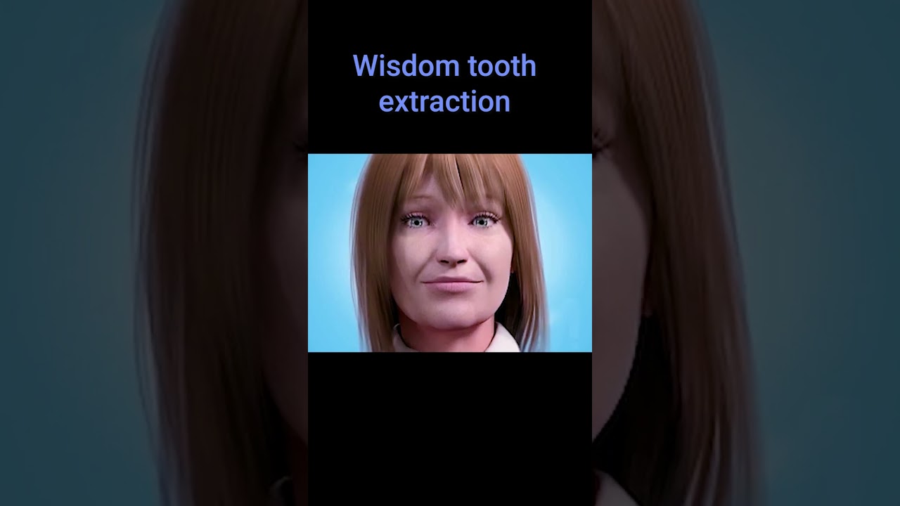 Nhổ Răng Khôn Mọc Nghiêng 45° An Toàn