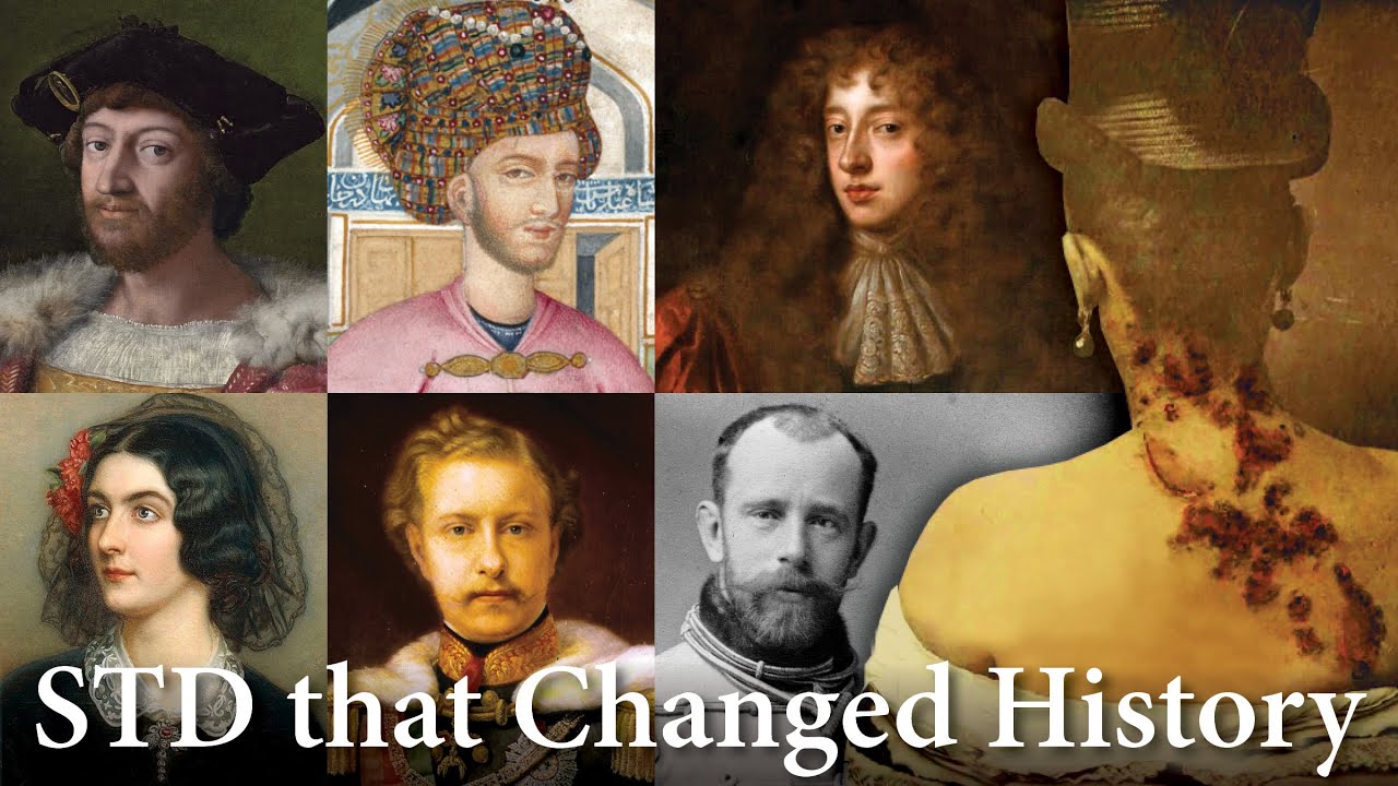 Royal Secrets and Scandal: The Hidden History of Syphilis Among Nobles 👑