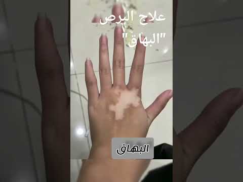#علاج #البرص #البهاق