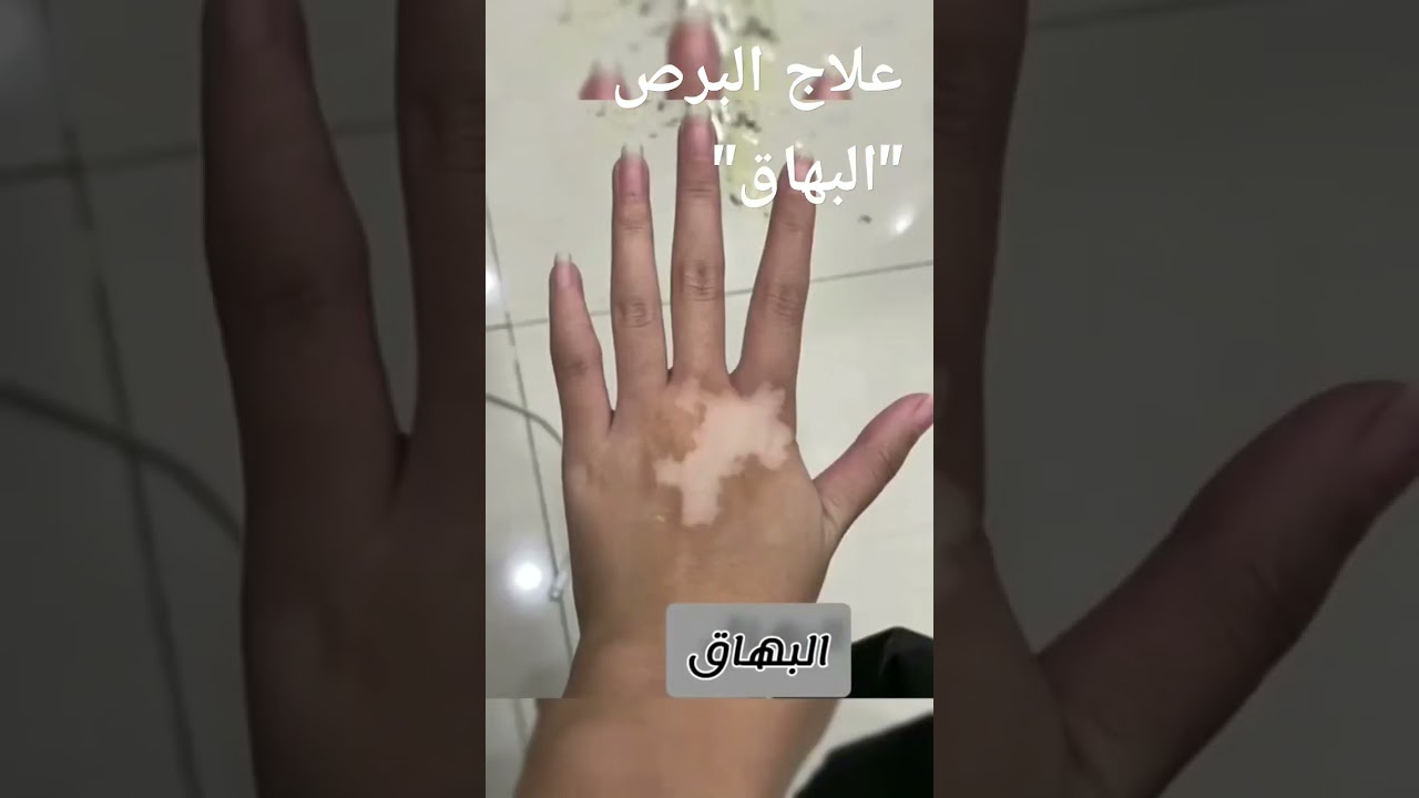 طرق فعالة لعلاج البرص والبهاق 🌟