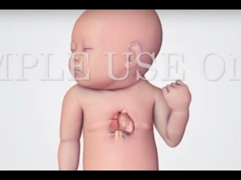 Hypoplastic Left Heart Syndrome (HLHS) Overview 🫀