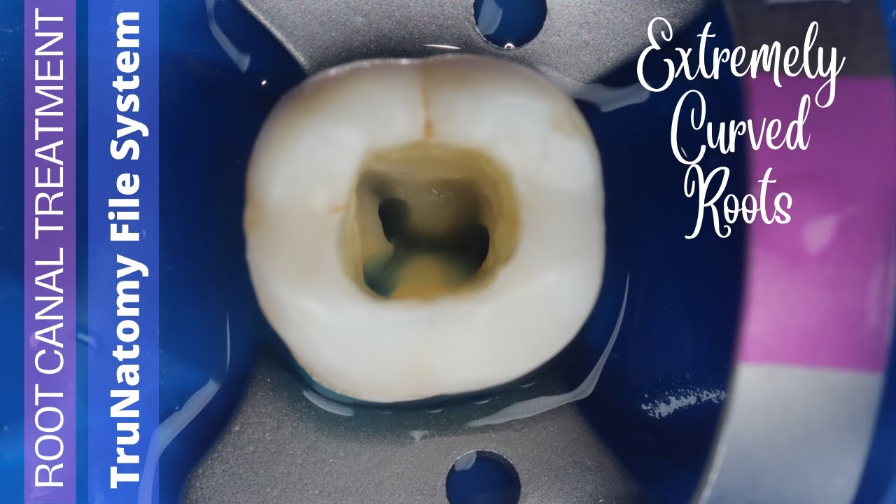 Root Canal in Mandibular Molar with TruNatomy π‘