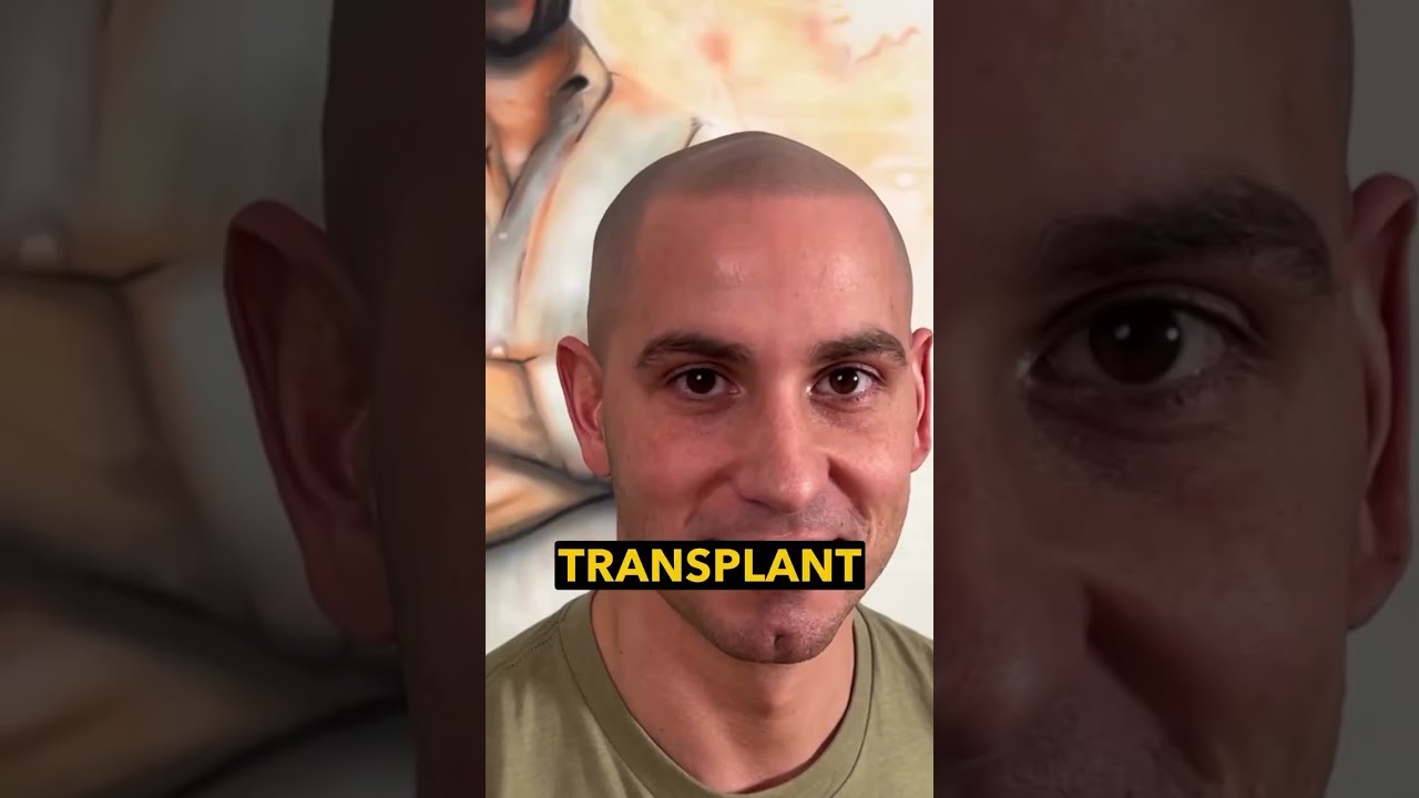 Scalp Micropigmentation & Hair Transplant: Which First? 🤔
