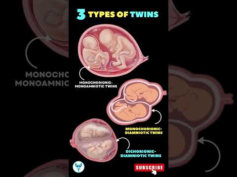 3 Types of Twins 🚼 🚼 Twin Pregnancy | Different types of Twins #shortsfeed #pregnancy #baby #twin