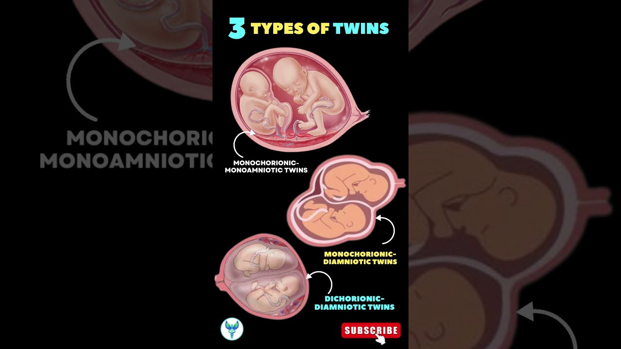 3 Types of Twins in Pregnancy | Understanding Twin Types