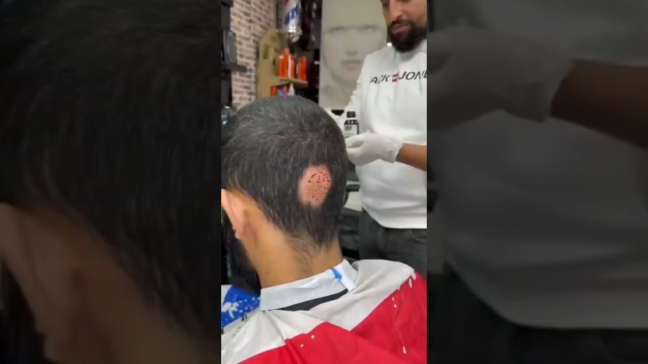 علاج الثعلبه في الراس مضمونه بفضل الله