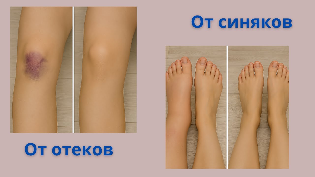 Быстрый способ убрать синяк дома 🏠