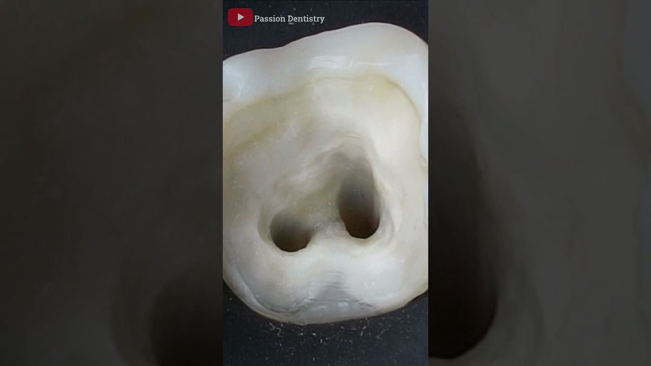 Root Canal Access Tips π¦· #Shorts