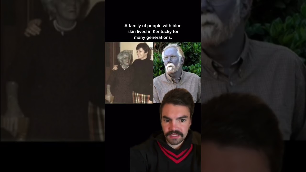 The Blue Fugates: Kentucky’s Family with Rare Blue Skin 💙