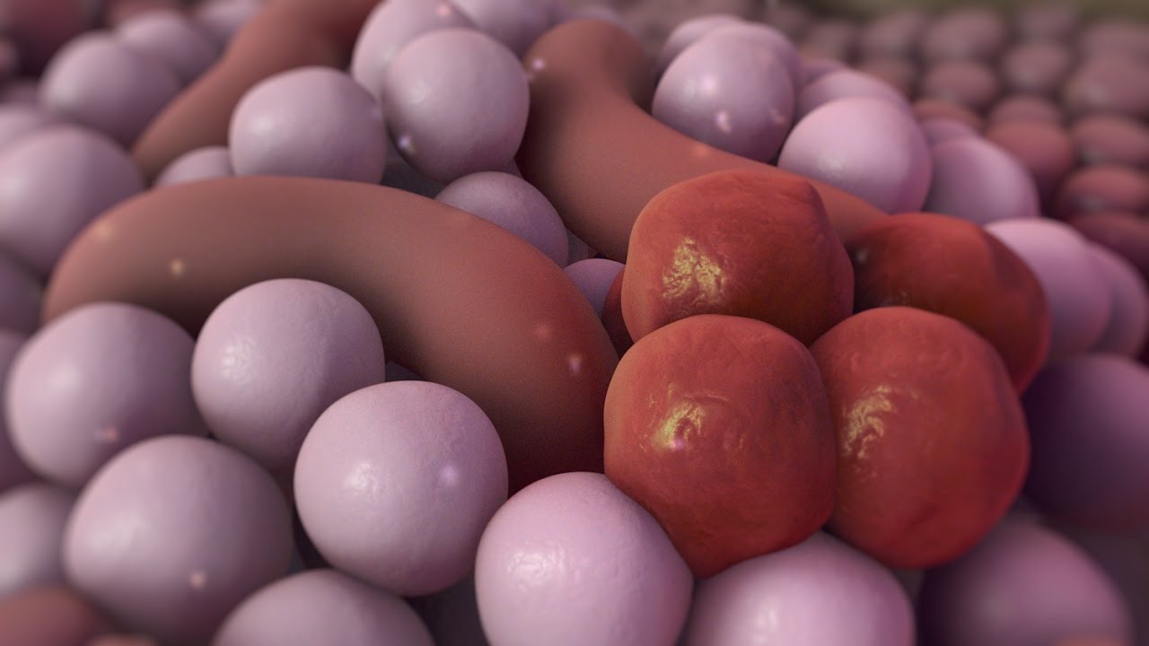 Understanding Pancreatic Cancer ποΈ