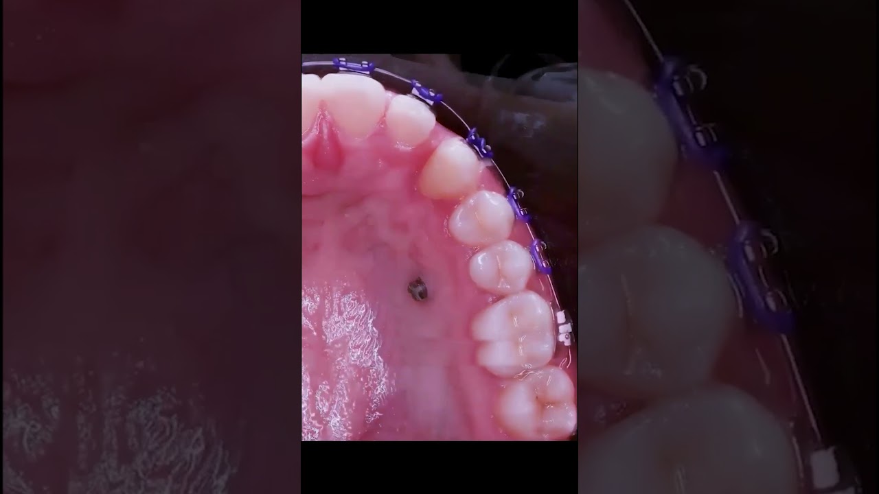 Kéo Răng: Quy trình và Lợi ích 🦷