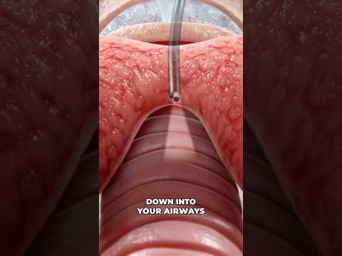 Bronchoscopy (3D Animation)
