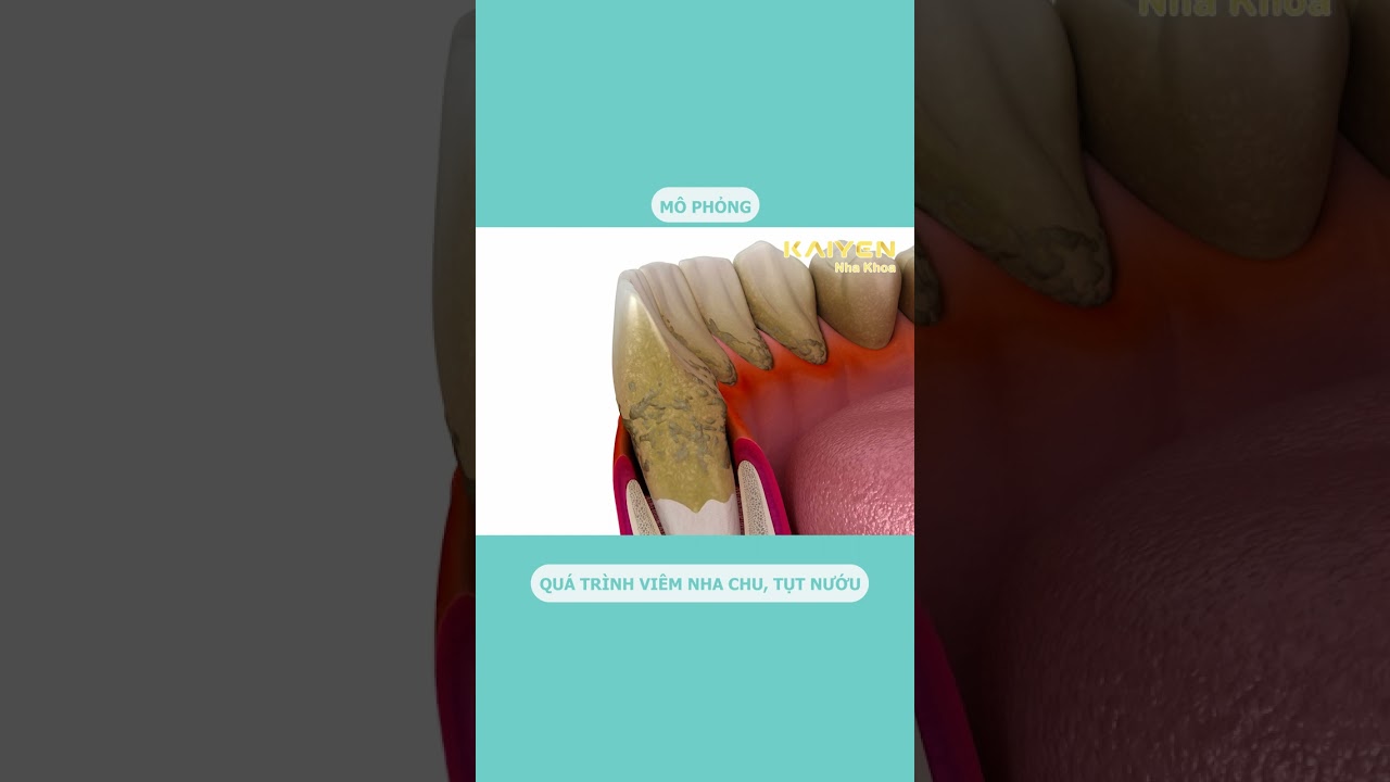 Viêm Nha Chu & Tụt Nướu - Nha Khoa KAIYEN 🦷