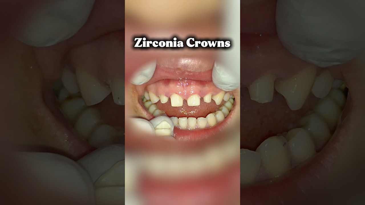 Zirconia Crowns for Fixed Teeth & Gap Closure