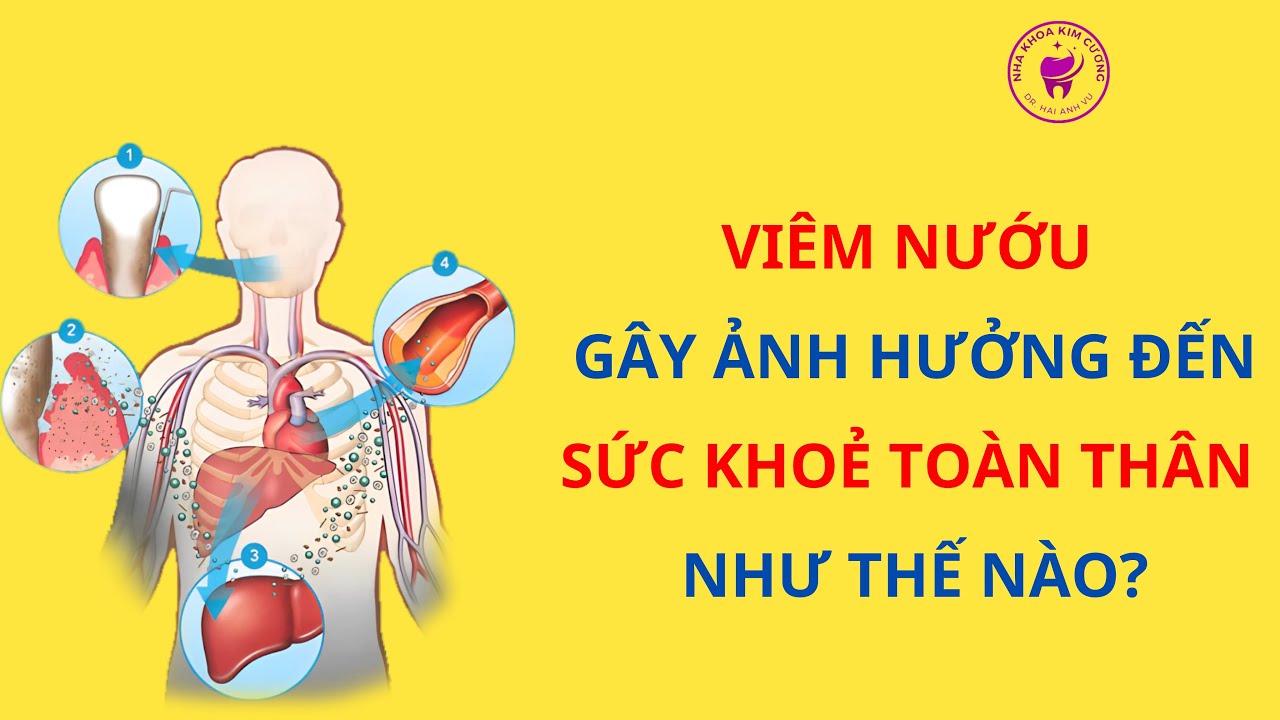 Viêm Nướu Ảnh Hưởng Đến Sức Khỏe Toàn Thân 🦷