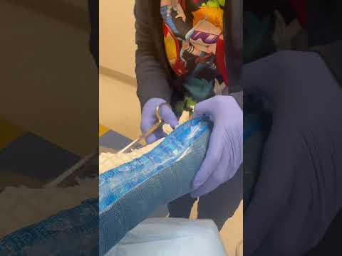 Cutting my cast off